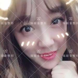 瑞麗舍整形馬君做的全臉自體脂肪填充，不錯(cuò)呢~