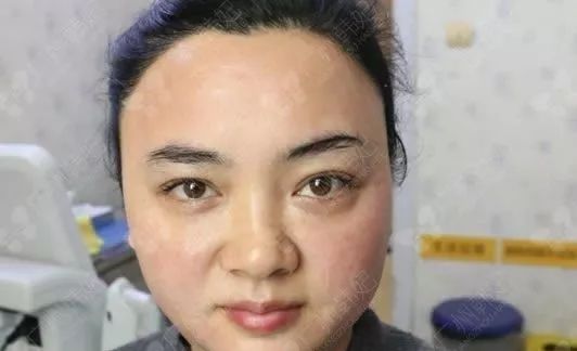 廣州韓妃美版超聲提拉和埋線提升提升日記一則，給你好看~