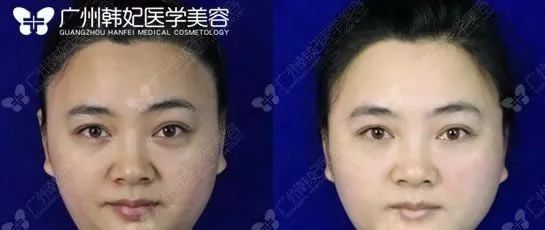 廣州韓妃美版超聲提拉和埋線提升提升日記一則，給你好看~