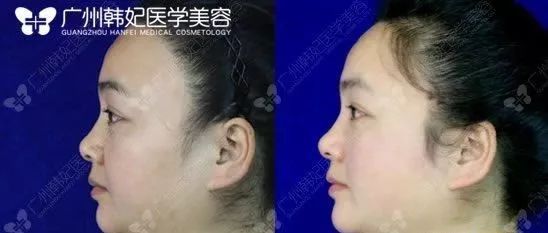 廣州韓妃美版超聲提拉和埋線提升提升日記一則，給你好看~