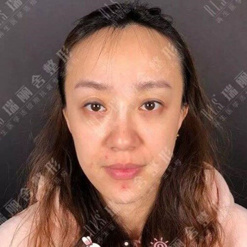 手術(shù)前臉頰凹陷嚴重的照片