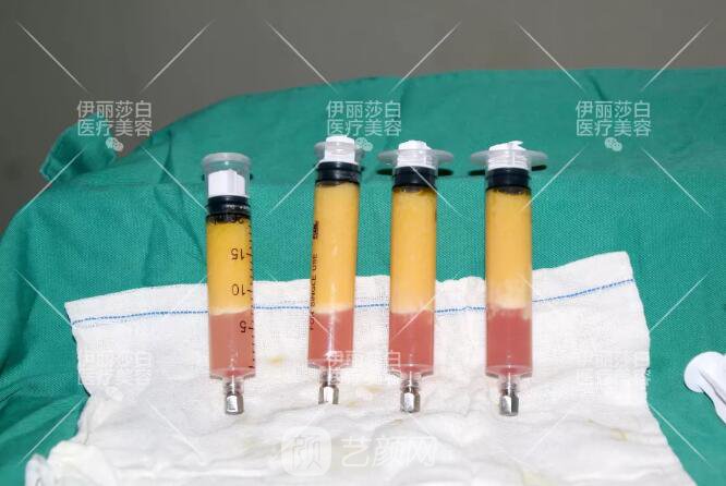 惠州伊麗莎白整形醫(yī)院自體脂肪豐胸圖 豐胸圖鑒