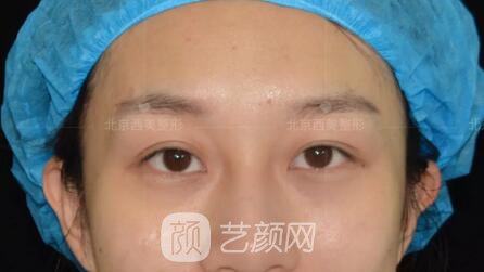 北京西美整形全切雙眼皮，徹底拯救我的大小眼
