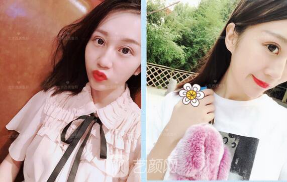 北京西美整形全切雙眼皮，徹底拯救我的大小眼