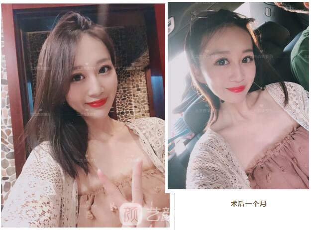 北京西美整形全切雙眼皮，徹底拯救我的大小眼