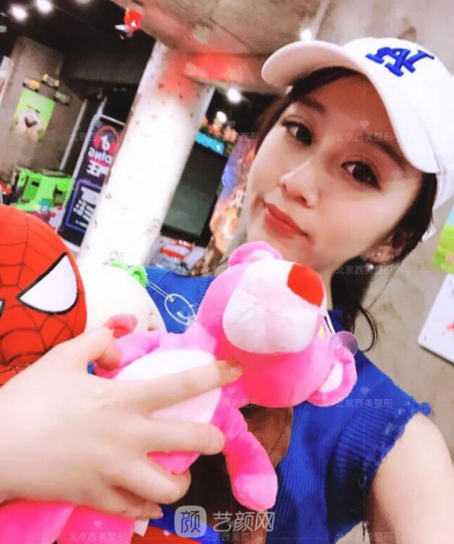 北京西美整形全切雙眼皮，徹底拯救我的大小眼