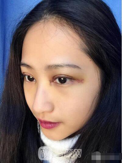 萍鄉(xiāng)優(yōu)美整形李清芳全切雙眼皮照片 拯救眼睛不對稱