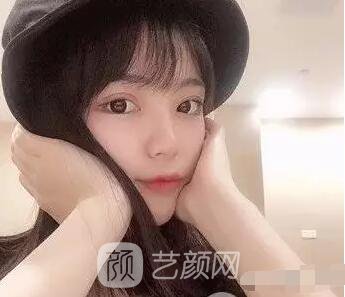 上海伊美爾港華醫(yī)院開雙眼皮圖 大小眼的救星