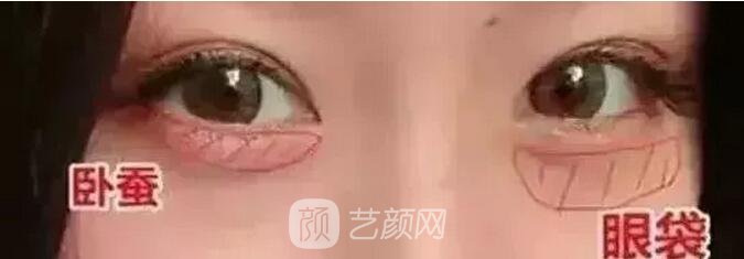 北京藝星整形Yestar分齡祛眼袋真實(shí)案例圖分享哦~