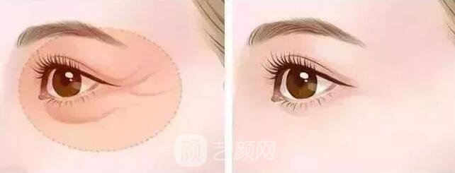 北京藝星整形Yestar分齡祛眼袋真實(shí)案例圖分享哦~