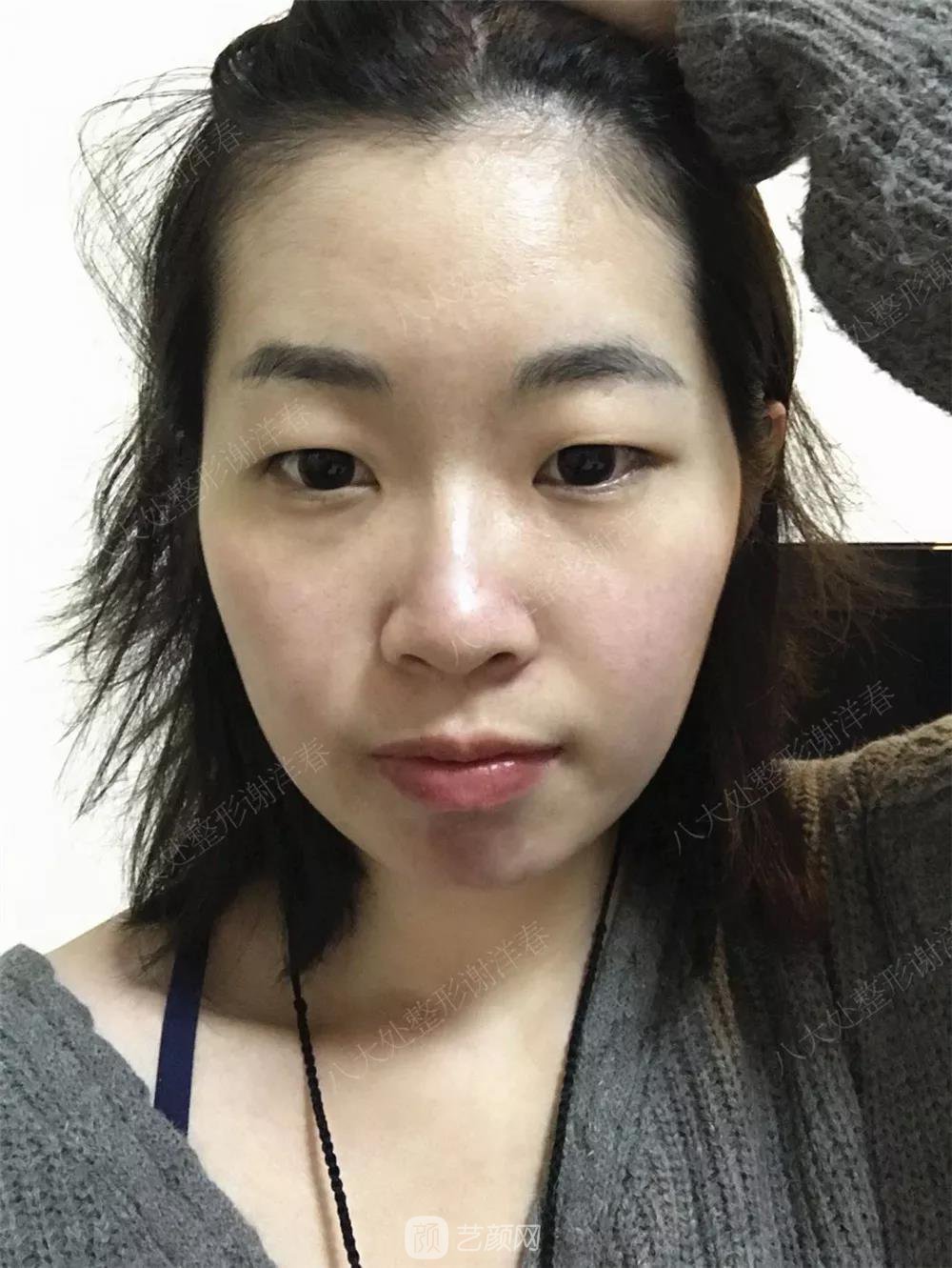 北京八大處割雙眼皮恢復(fù)過程，內(nèi)附圖
