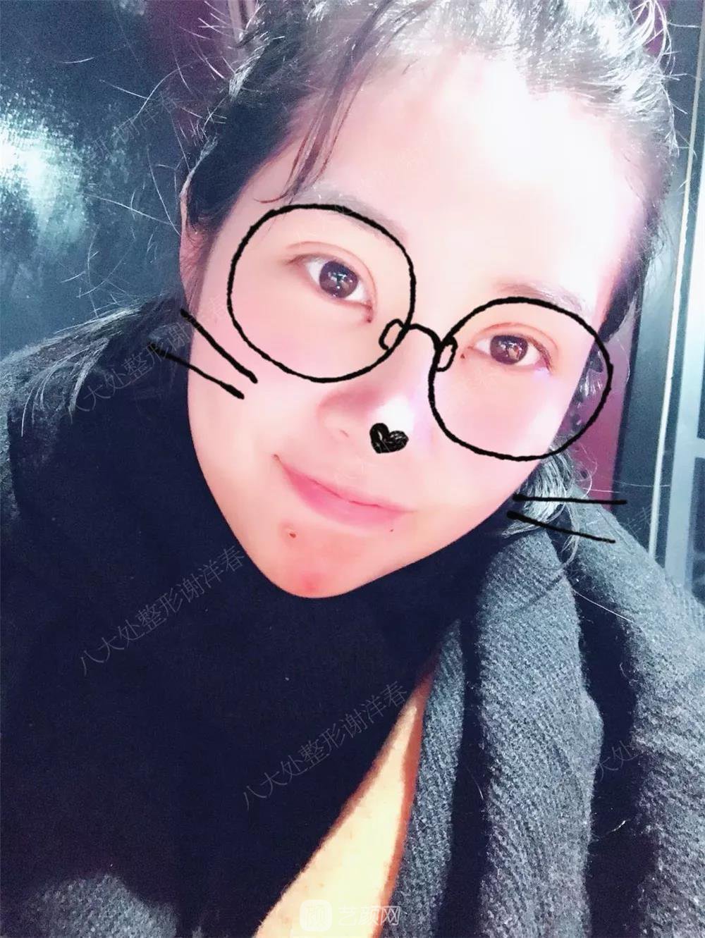 北京八大處割雙眼皮恢復(fù)過程，內(nèi)附圖