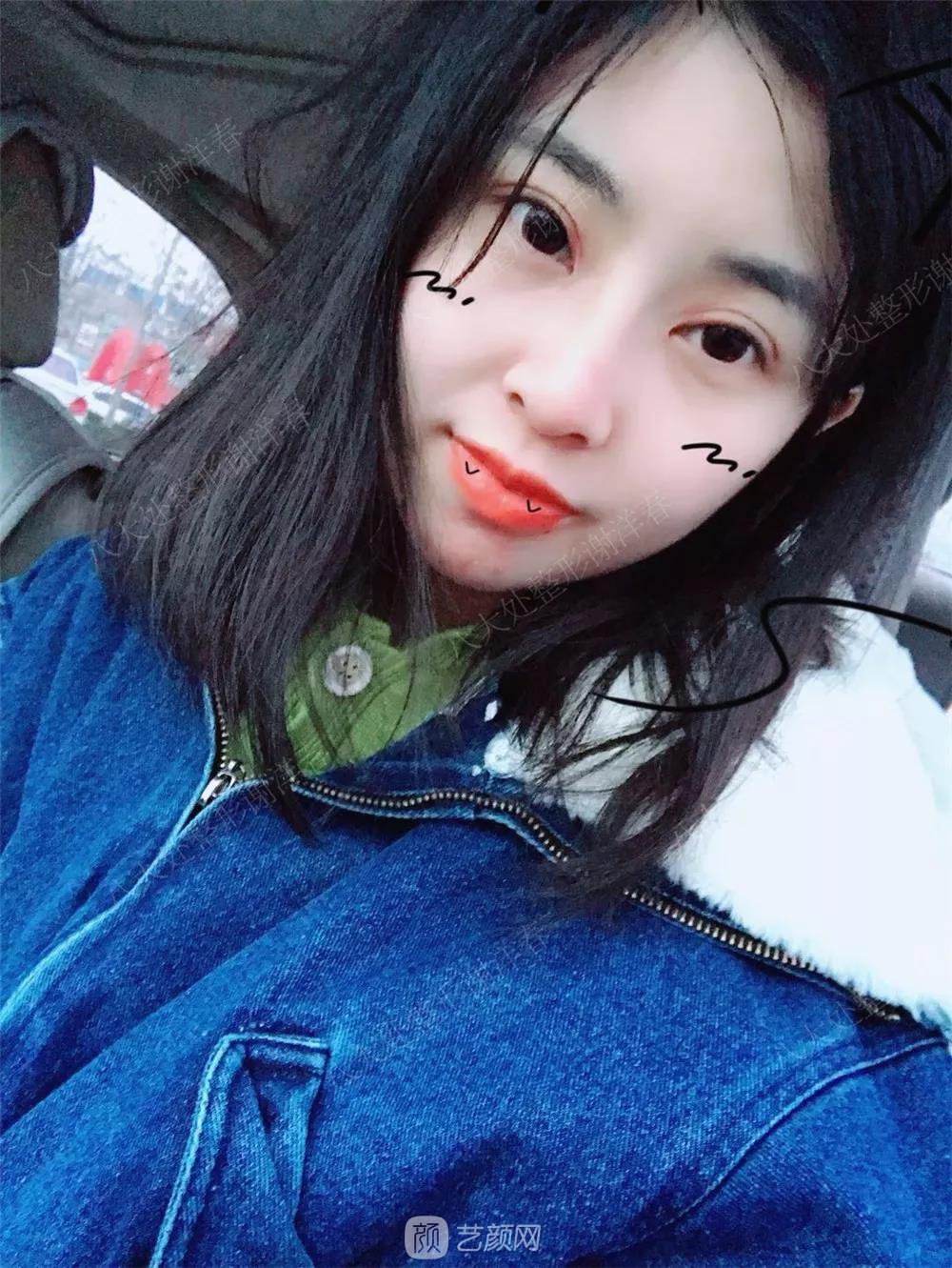 北京八大處割雙眼皮恢復(fù)過程，內(nèi)附圖