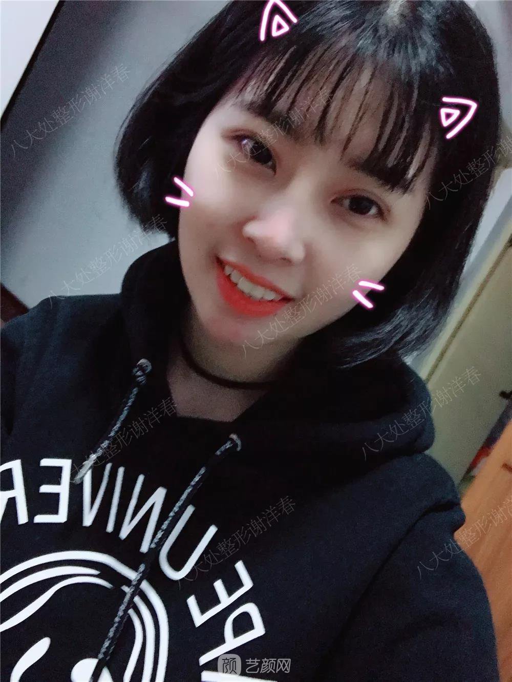 北京八大處割雙眼皮恢復(fù)過程，內(nèi)附圖