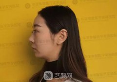 華美紫馨整形醫(yī)院隆鼻修復(fù)案例恢復(fù)全過程|內(nèi)附圖哦