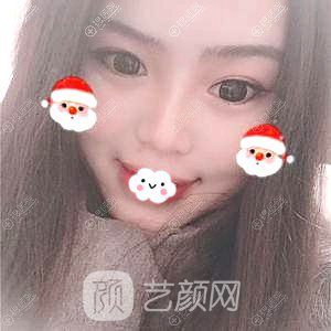 四川隆鼻哪家醫(yī)院好？成都成美馮春雨硅膠隆鼻+假體墊下巴恢復(fù)果圖