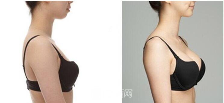 做雪藍(lán)貝假體隆胸能維持多長(zhǎng)時(shí)間