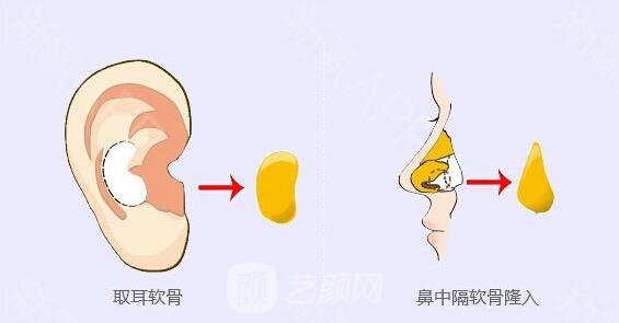 軟骨移植重塑鼻尖適應(yīng)哪些人?