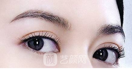 雙眼皮兩個(gè)月，是這個(gè)樣子的，大家來看看