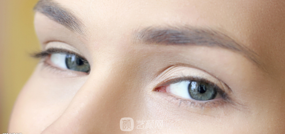 雙眼皮手術(shù)類型太多，怎么選擇?