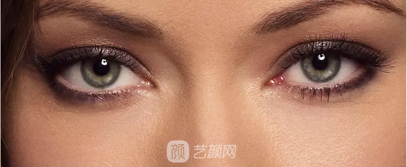 雙眼皮手術(shù)類型太多，怎么選擇?