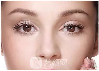 做完雙眼皮兩個月，簡直跟換了個人似的