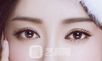 做完雙眼皮兩個月，簡直跟換了個人似的