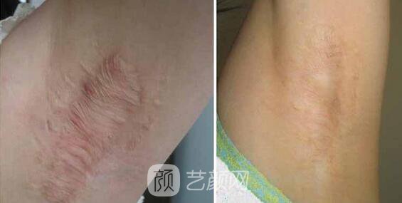 廣州曙光美容醫(yī)院疤痕專家怎樣