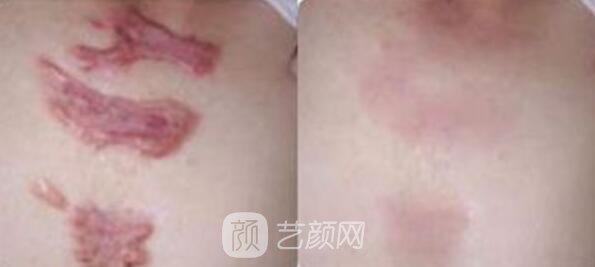 廣州曙光美容醫(yī)院疤痕專家怎樣