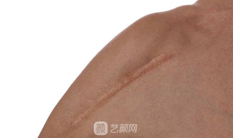 杭州激光去疤費用，多久見