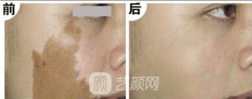 湖南激光祛斑好嗎？