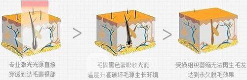 南昌紅蘋果做脫毛怎么樣?我們用實際情況來說話