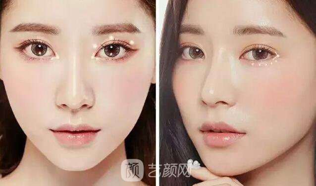 韓式切開雙眼皮的真實過程及恢復體驗分享~~
