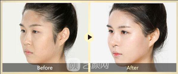 面部去皺術(shù)有很多，選適合自己的才是王道