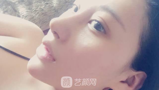 打注射瘦臉后臉真變小了，看來注射瘦臉真如傳聞所言