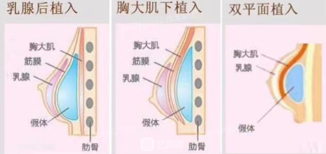 假體隆胸成就我的辣媽夢(mèng)！