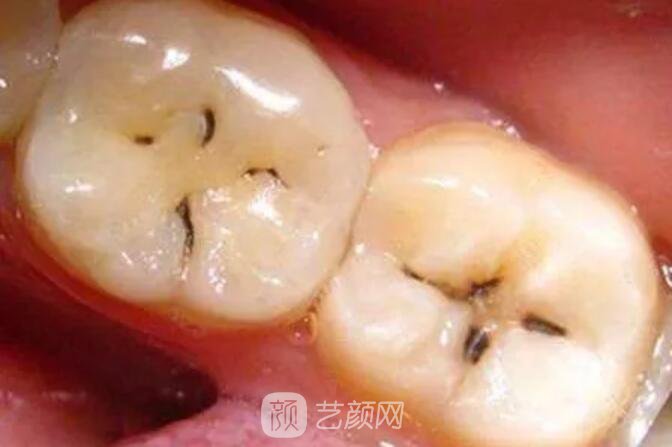 一口牙里，哪顆牙齒較容易長蛀牙？