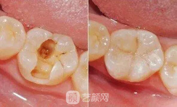 一口牙里，哪顆牙齒較容易長蛀牙？