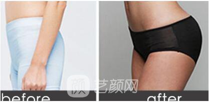 重慶埋線減肥怎么樣？