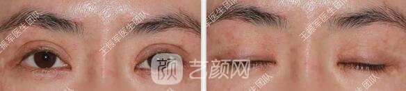 修復眼睛術(shù)前情況