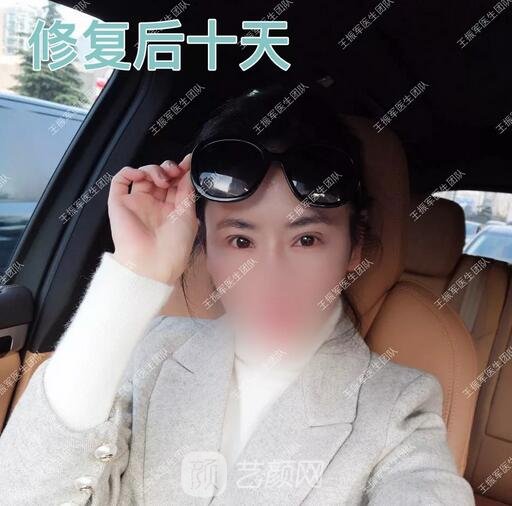 雙眼皮修復術(shù)后十天果圖