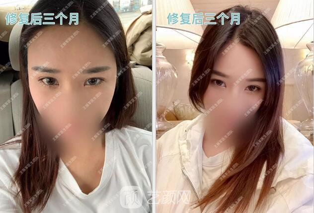 修復術后三個月果圖