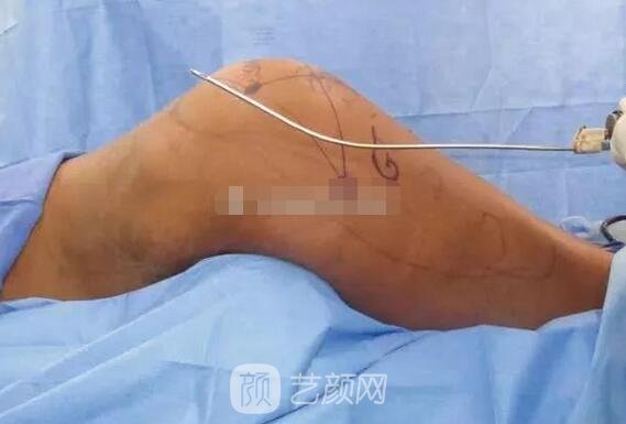 自體脂肪豐臀手術(shù)