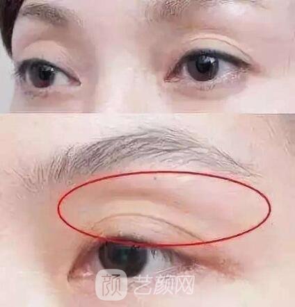 科普：自體脂肪填充眼窩后遺癥有這些，你造嗎？