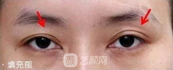 眼窩凹陷