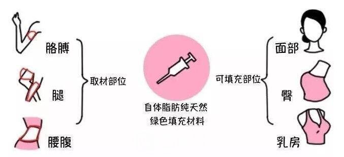脂肪填充過(guò)程圖