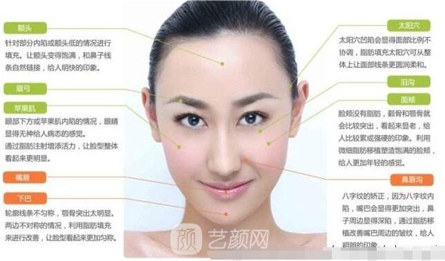 自體脂肪填充蘋果肌的后遺癥和副作用
