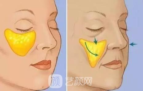 自體脂肪填充蘋果肌