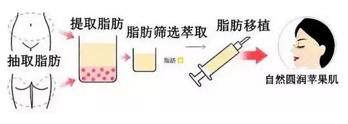 自體脂肪填充蘋果肌手術(shù)流程圖