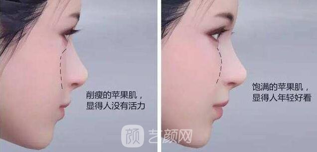 自體脂肪填充蘋果肌